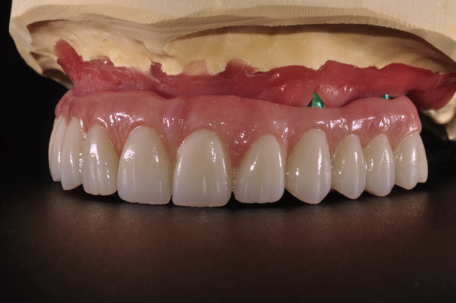 Upper full-arch restoration seated on multi-unit abutments