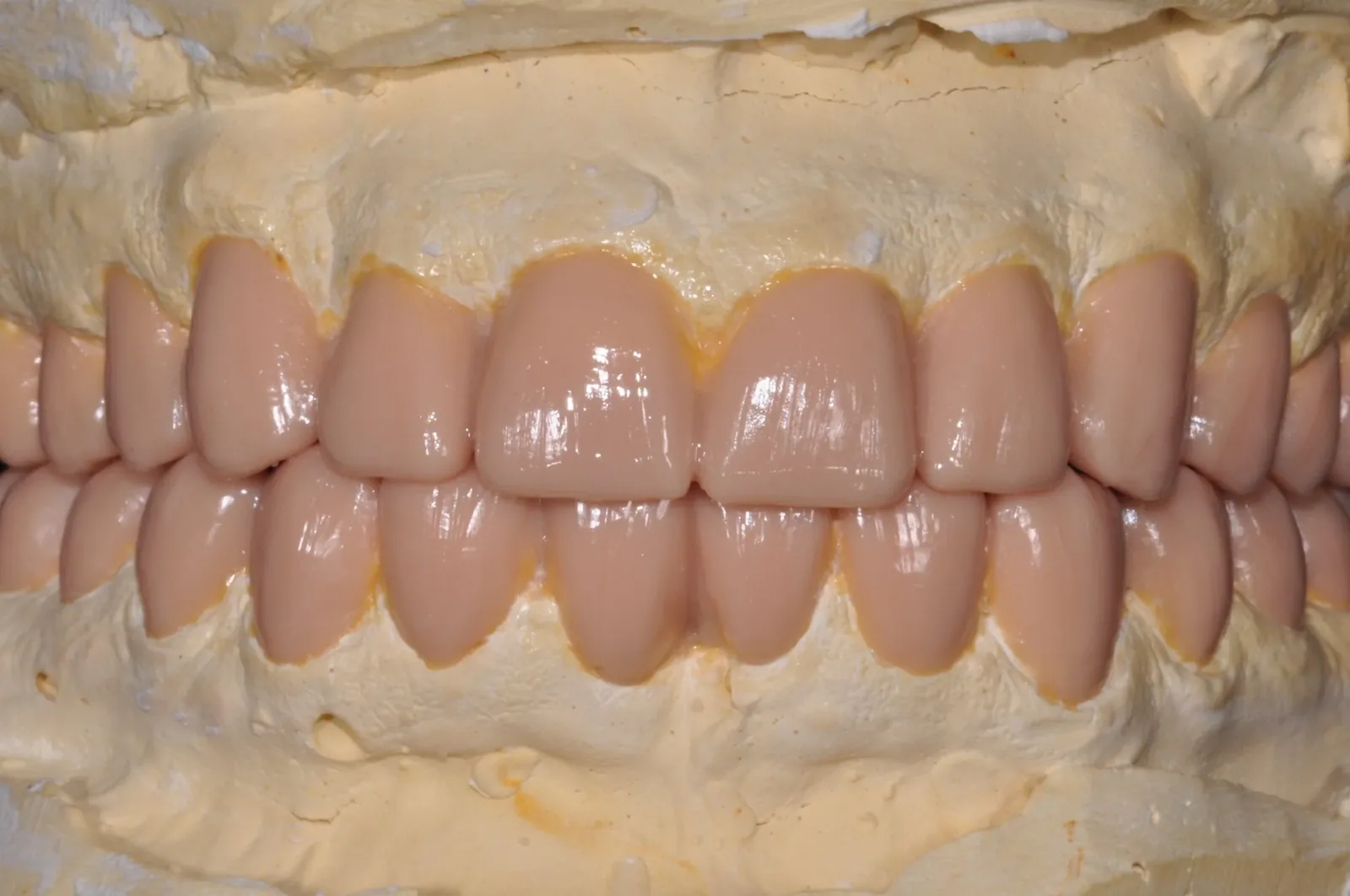 Diagnostic wax-up