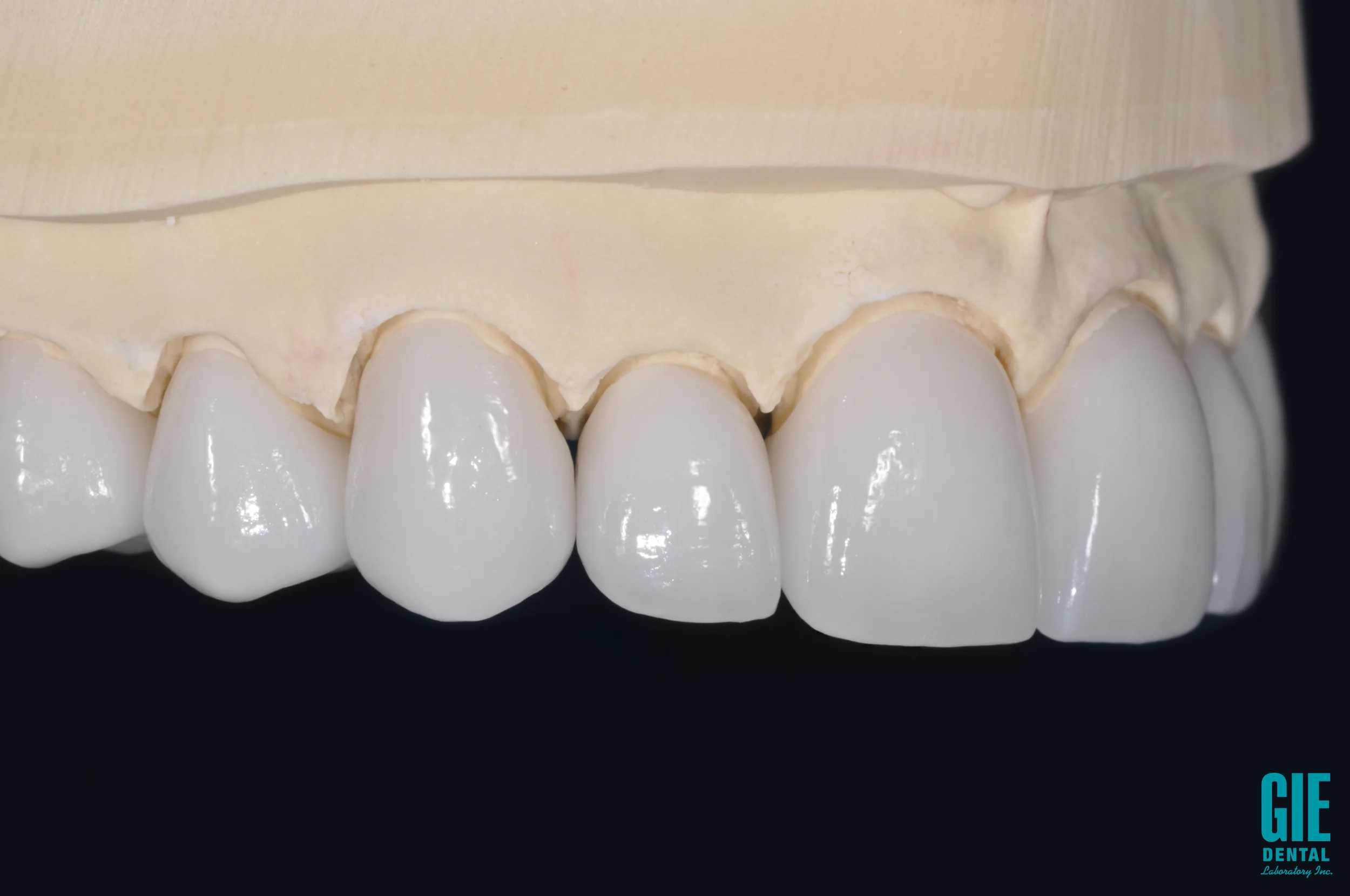 IPS e.max lithium disilicate crown anterior