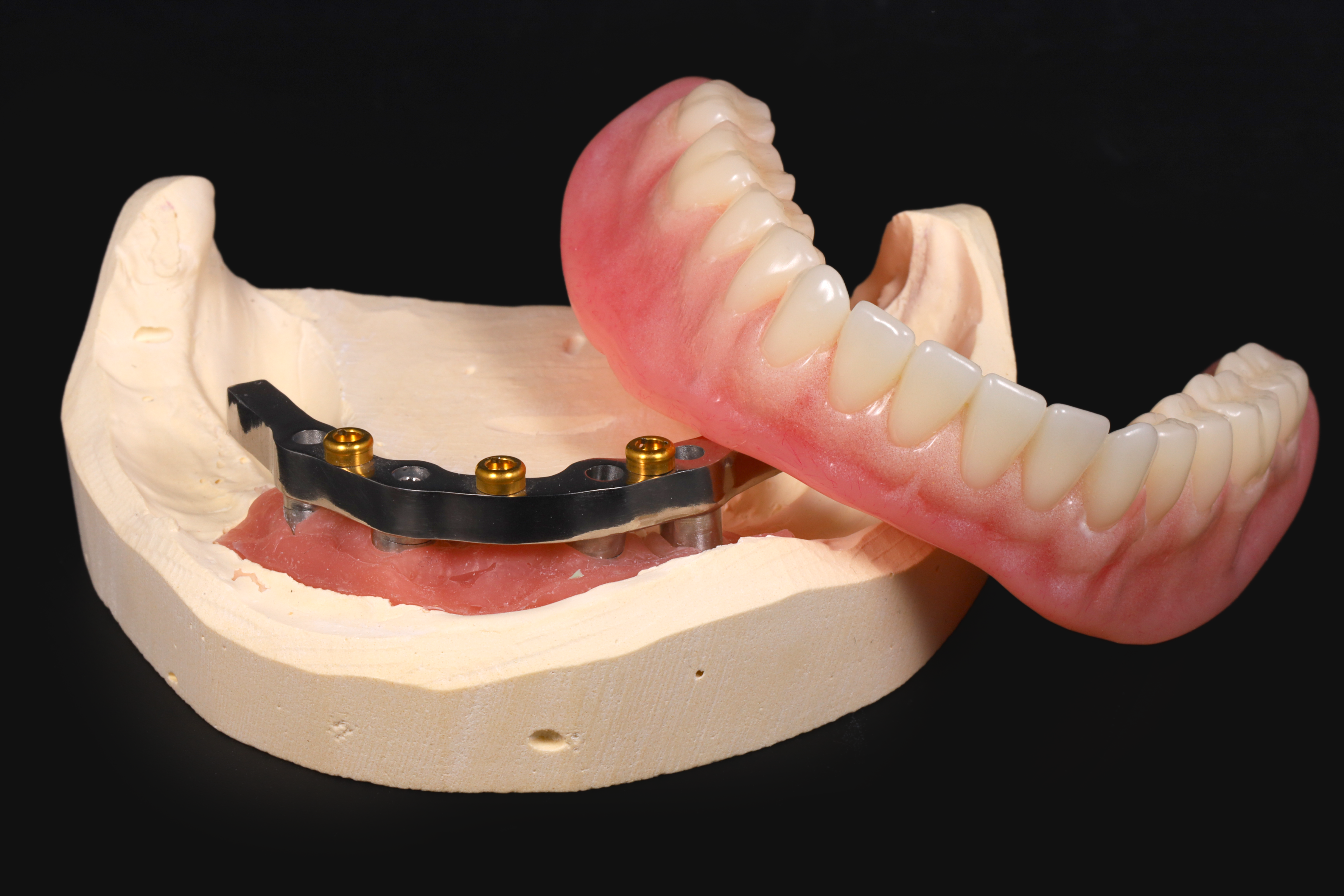 Locator bar implant overdenture