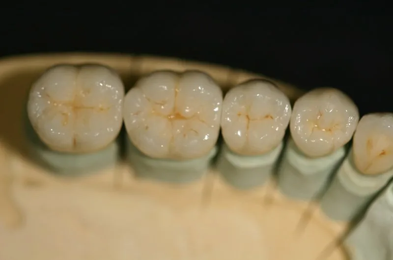 Porcelain-fused-to-metal PFM crown