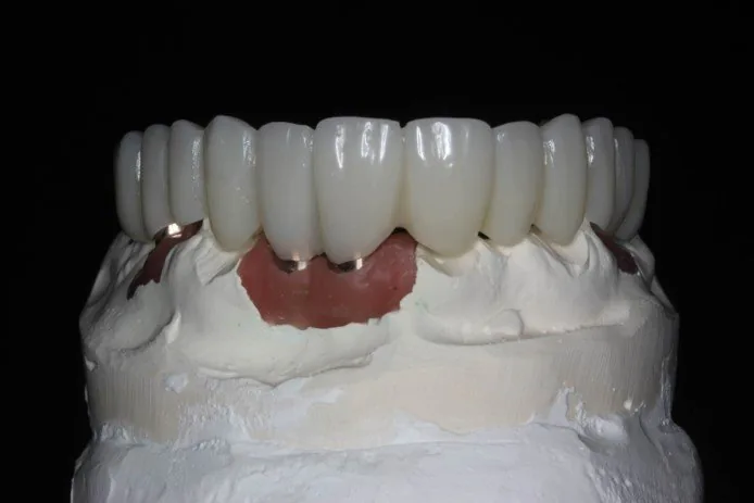 Milled PMMA provisional crown restoration