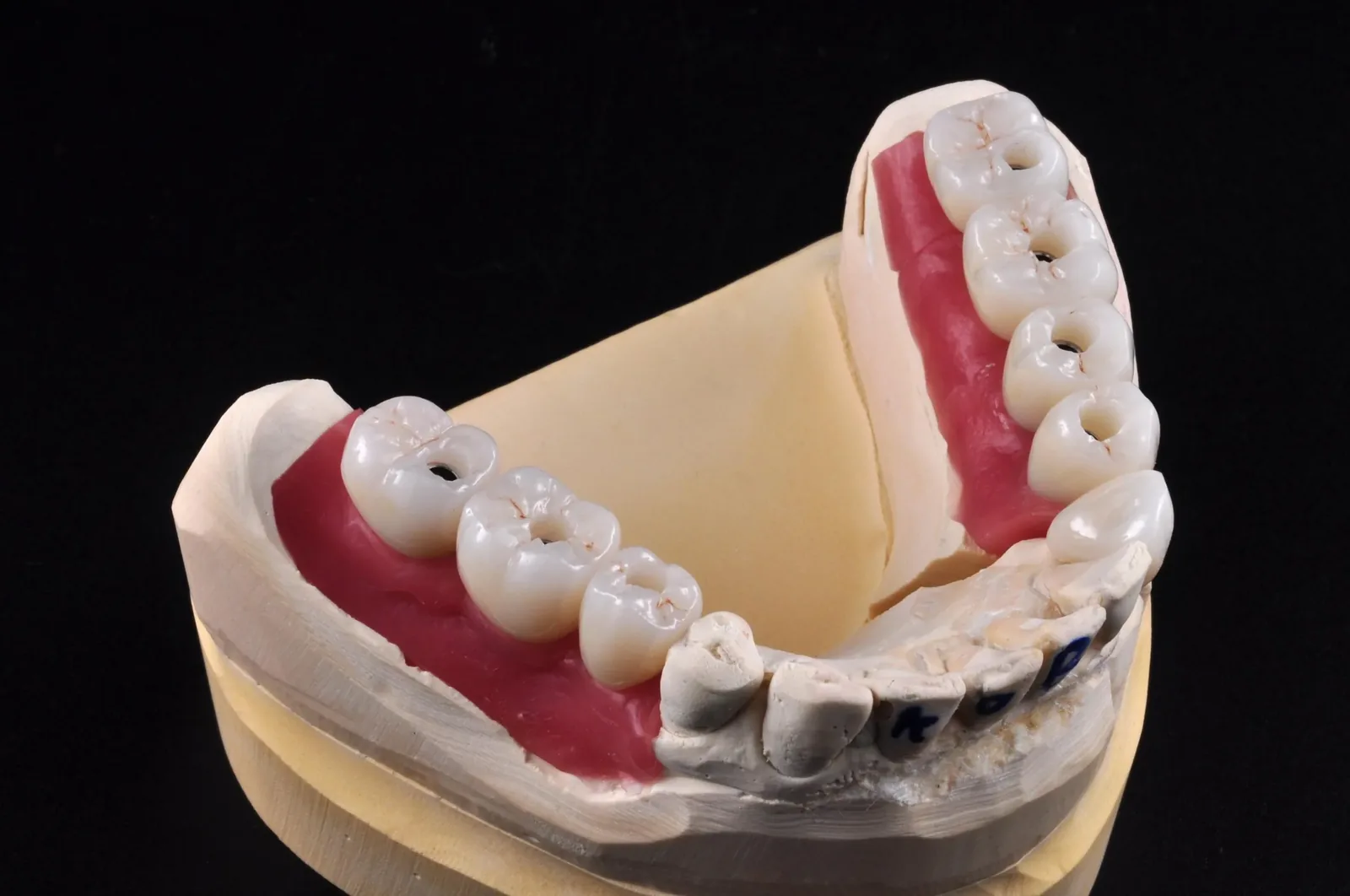 Multi-unit screw-retained crowns