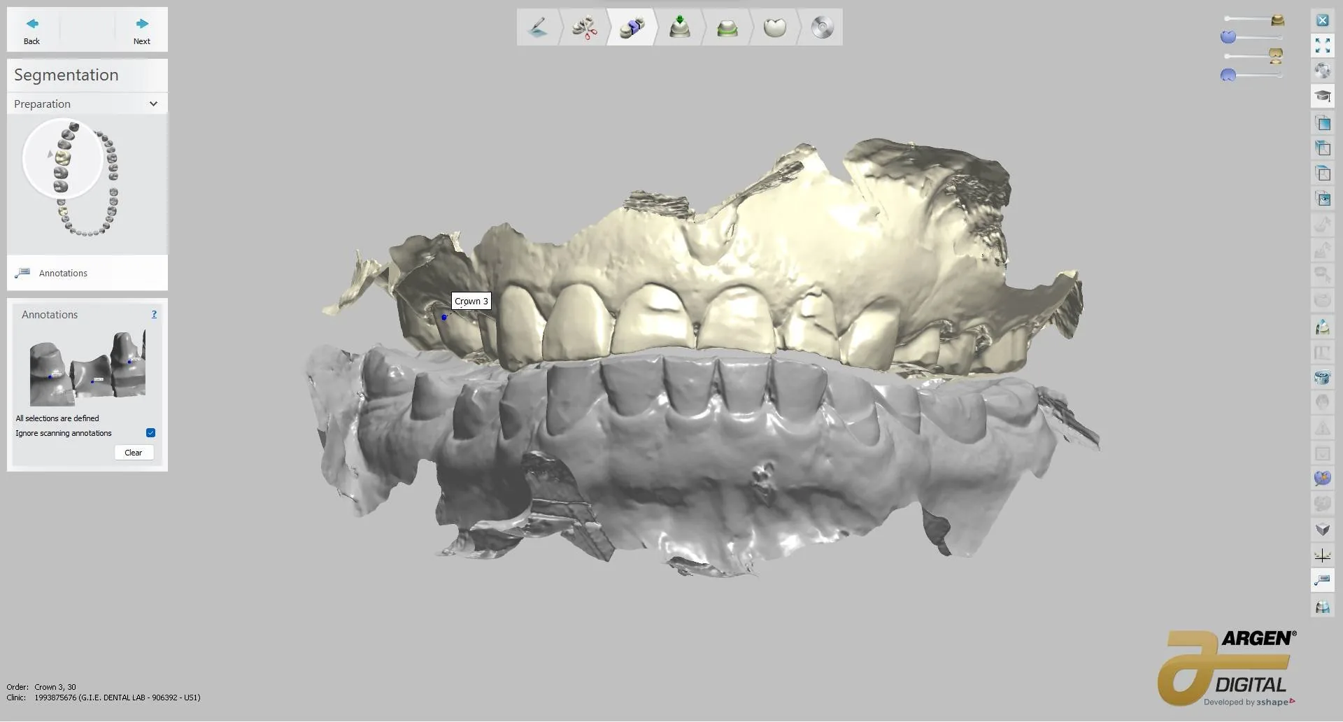 Digital diagnostic wax-up — before, pre-treatment study models