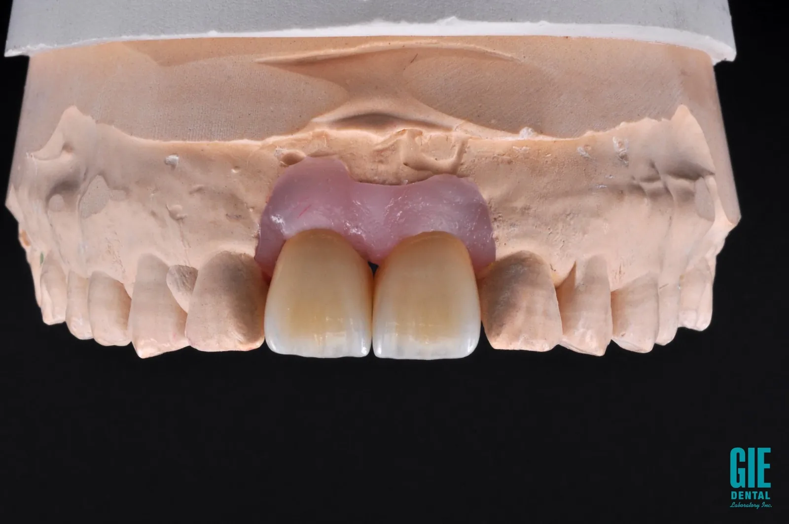 GIE CeraZi layered zirconia incisal restoration