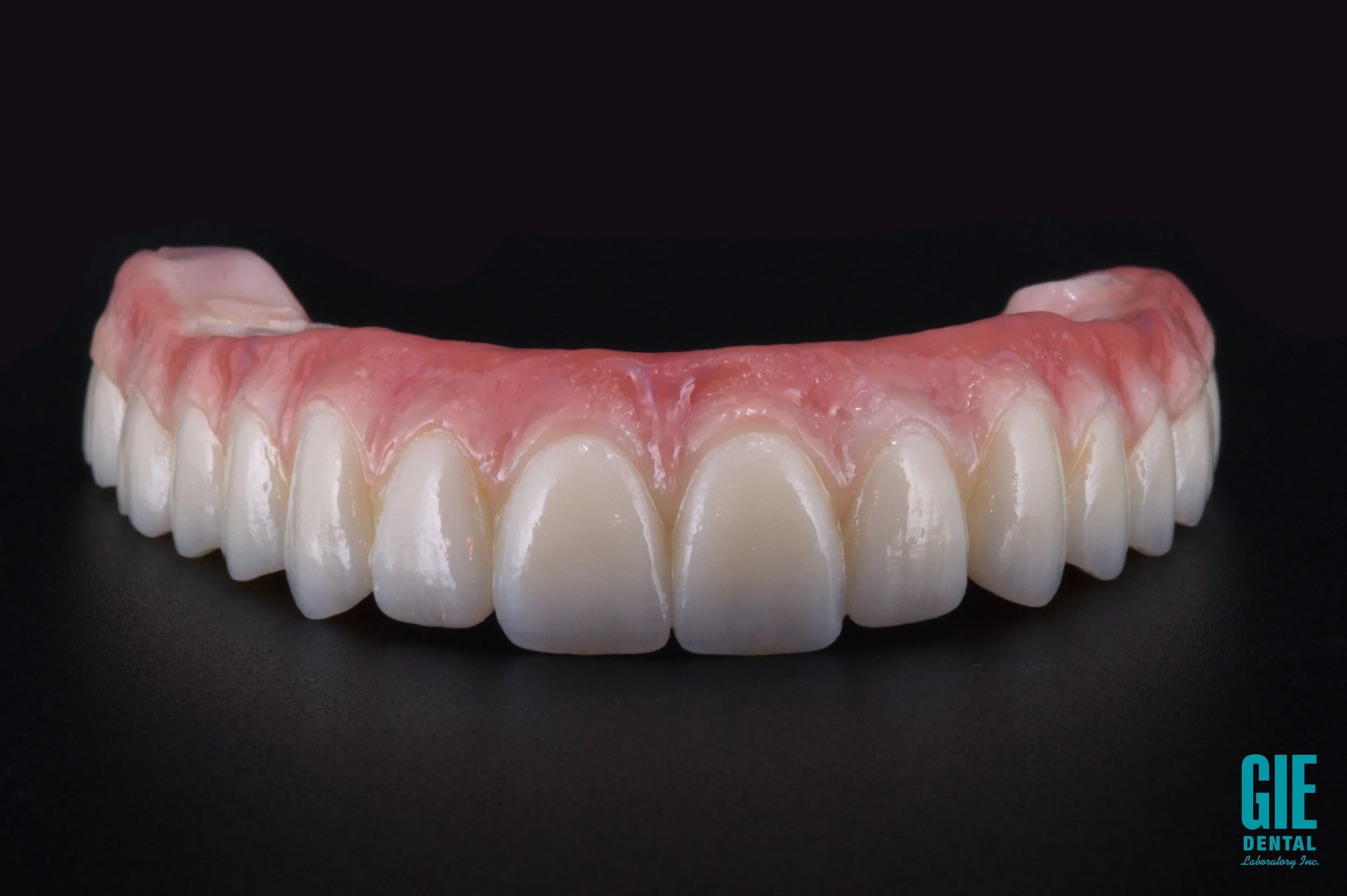 Full-zirconia implant bridge over multiple implants