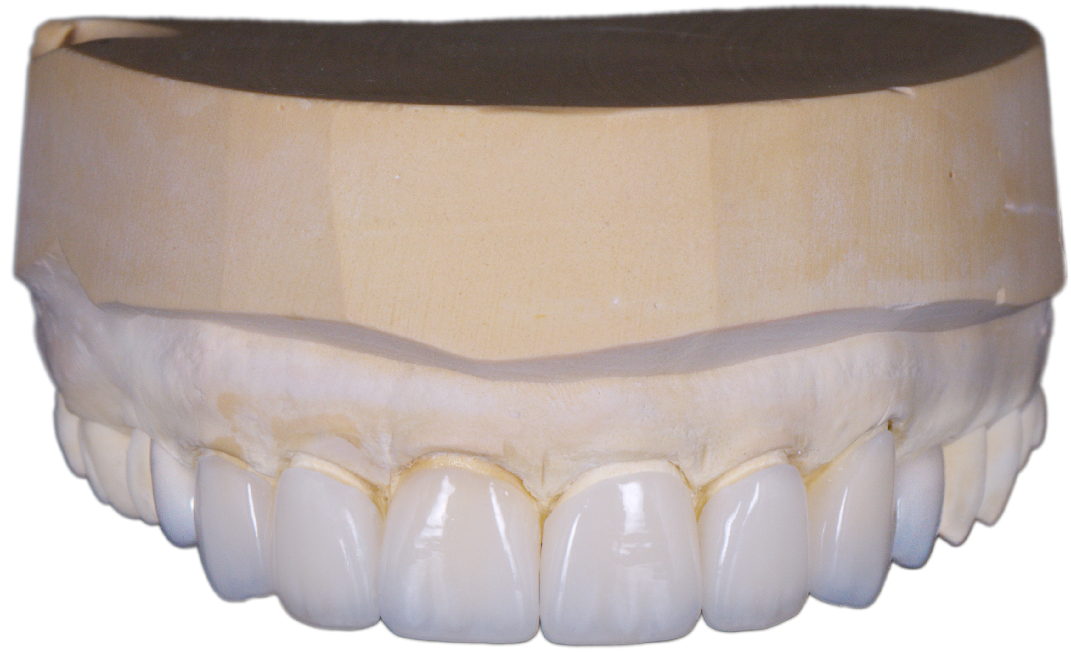 e.max upper 6-unit lithium disilicate all-ceramic restoration