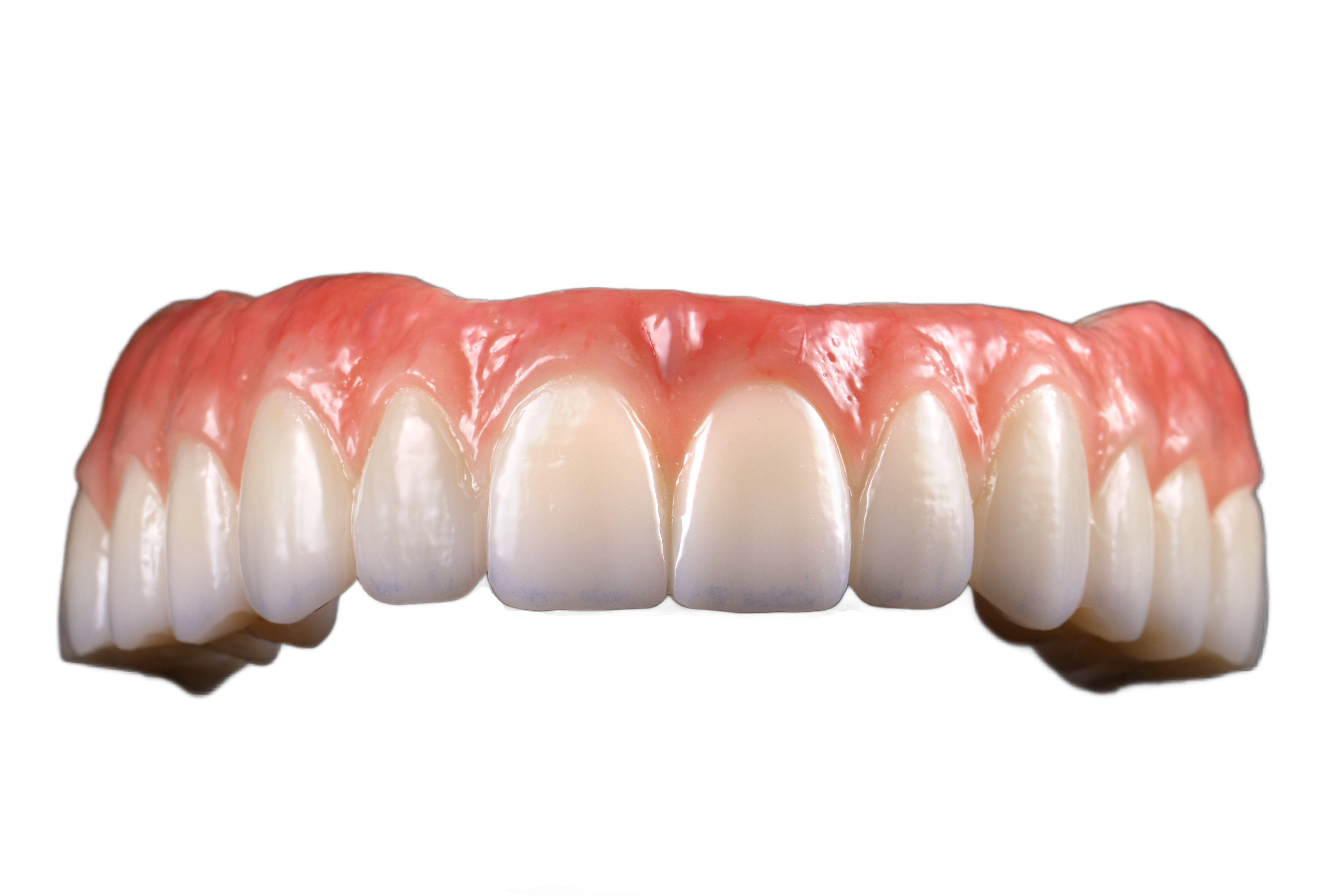 Full-arch All-on-X implant restoration designed at GIE Dental Lab