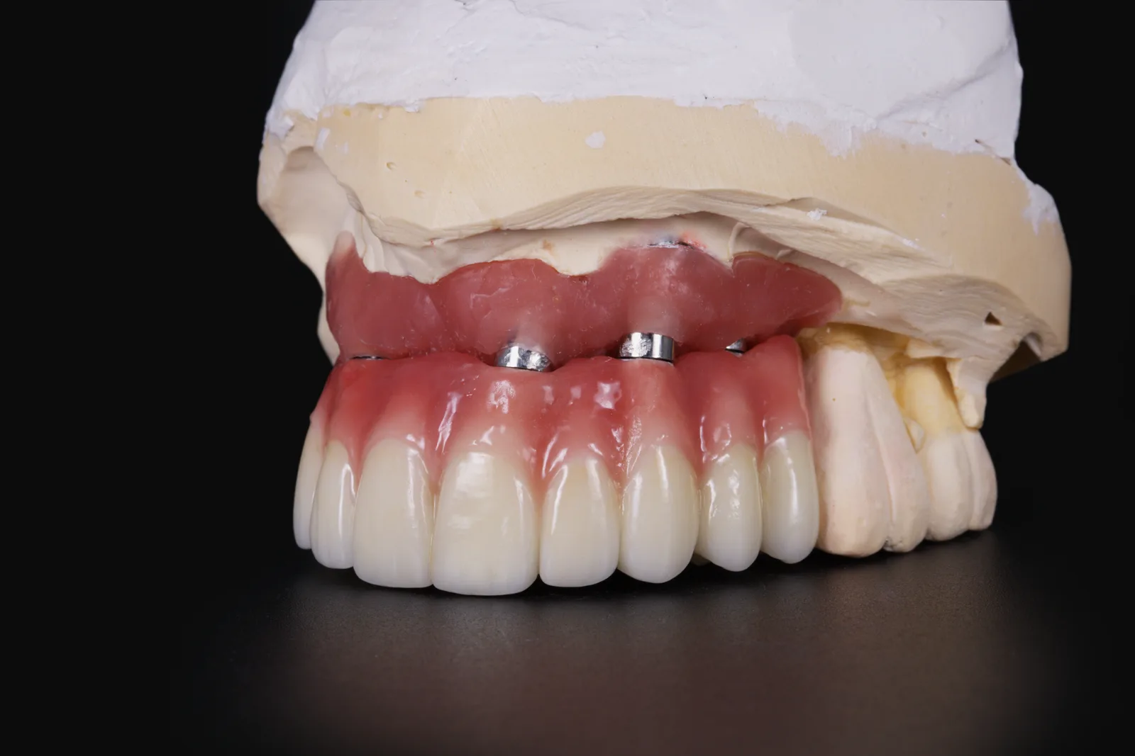 PFM implant bridge seated on model