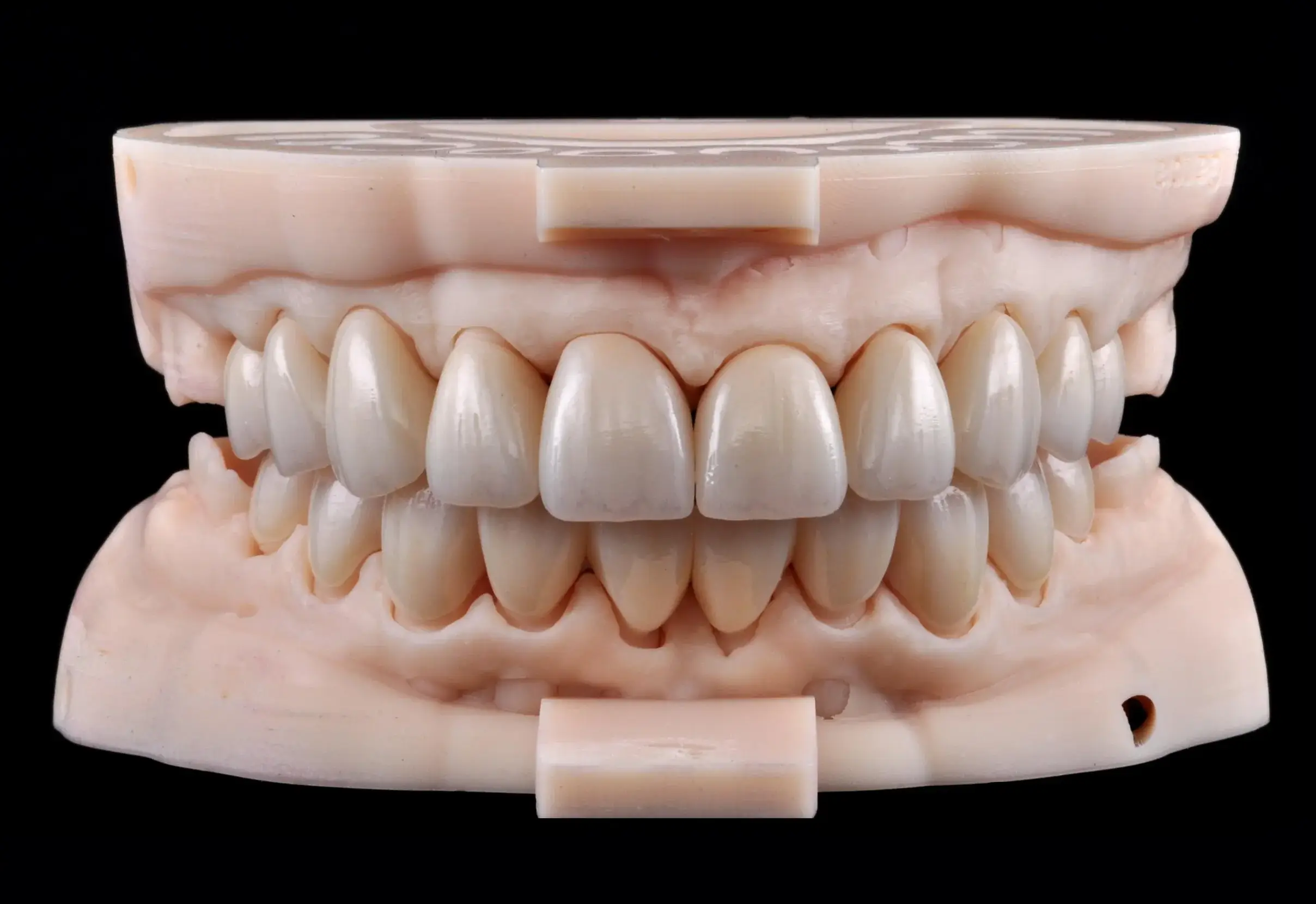 GIE PureZi 20-unit restoration — facial view