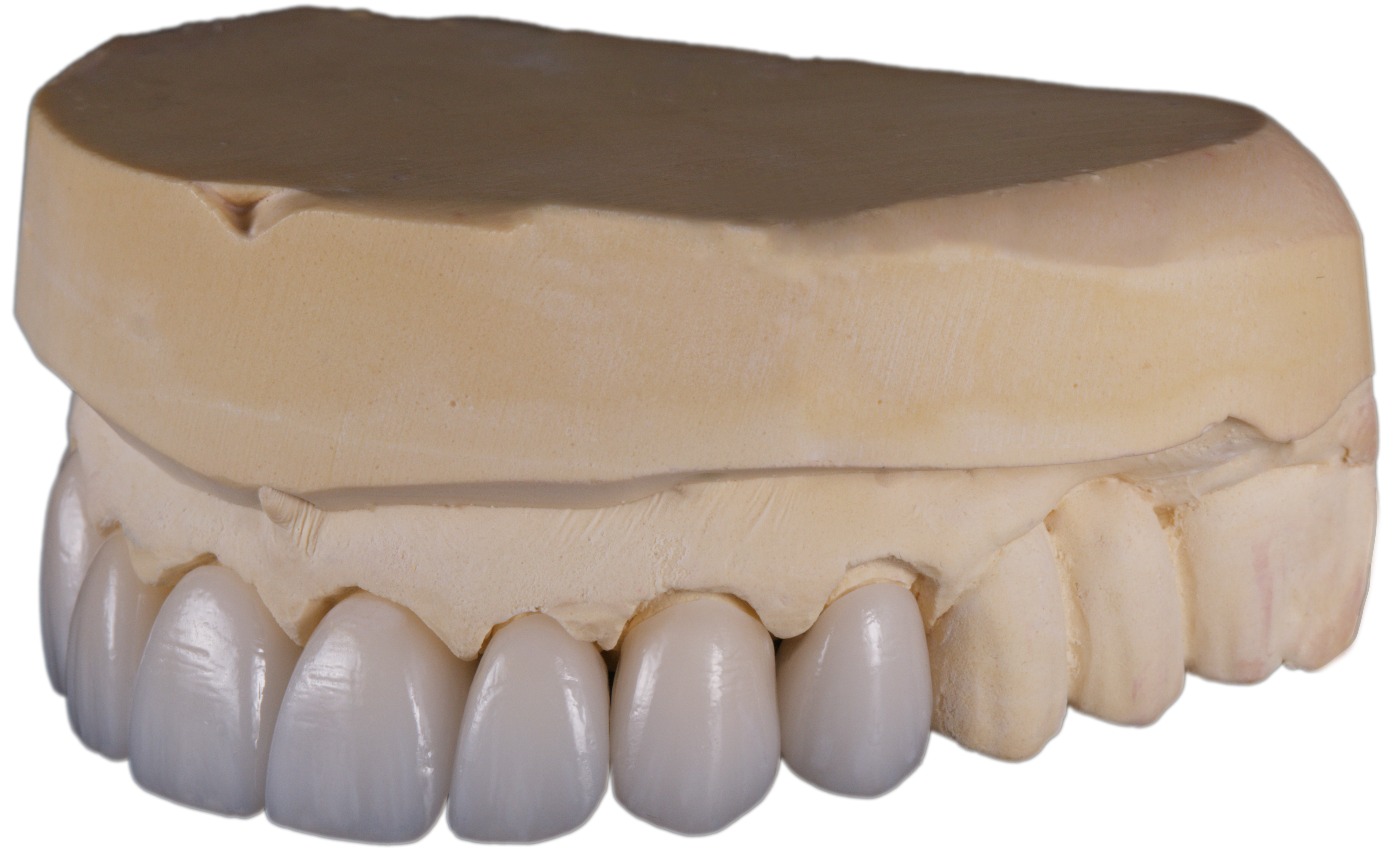 PureZi crown and bridge restoration