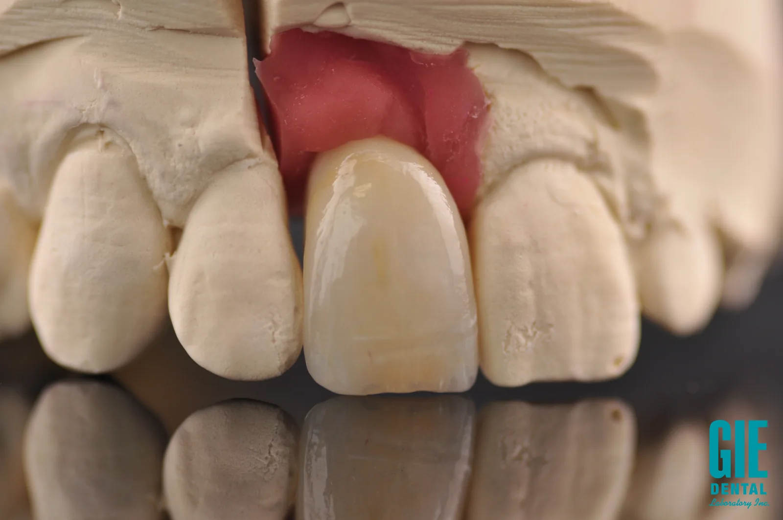 Screw-retained anterior implant crown