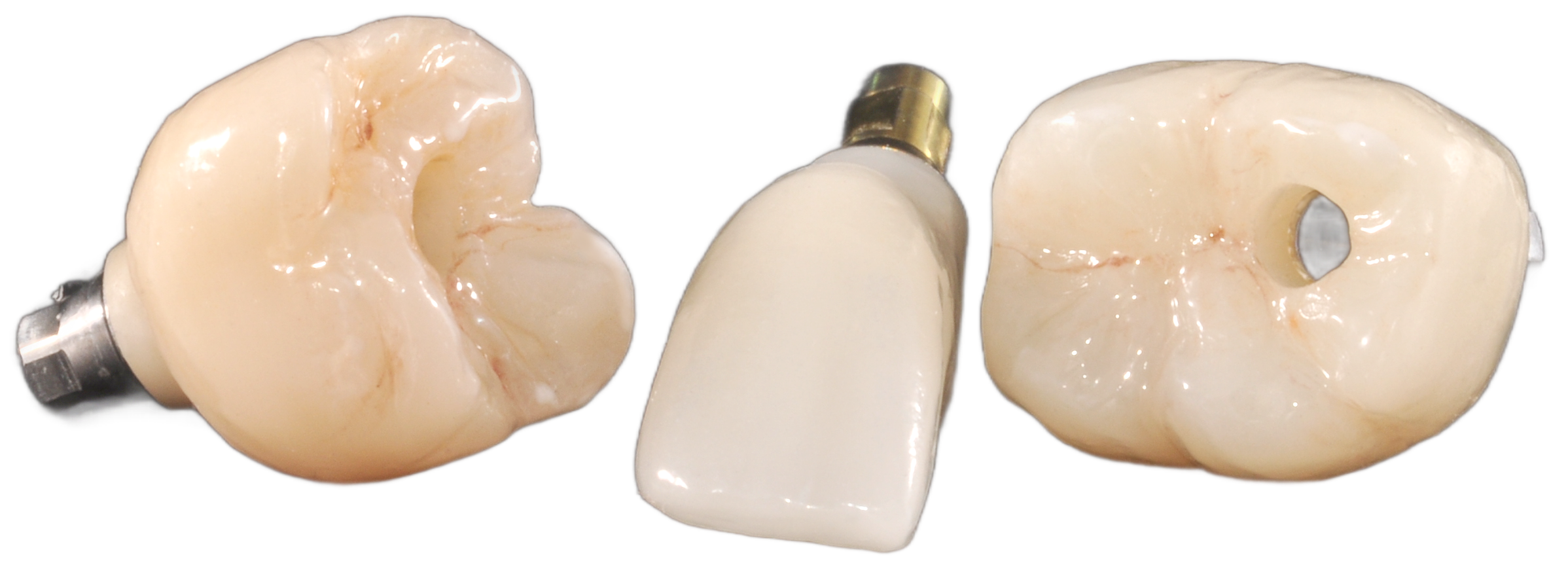 Screw-retained implant crowns anteriors and posteriors