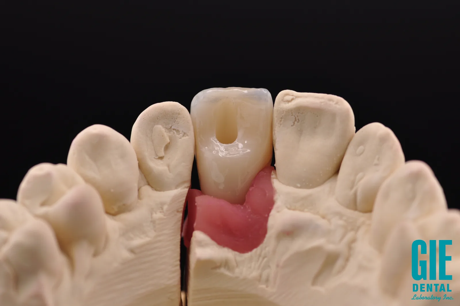 Palatal view of a screw-retained anterior crown showing the sealed access channel