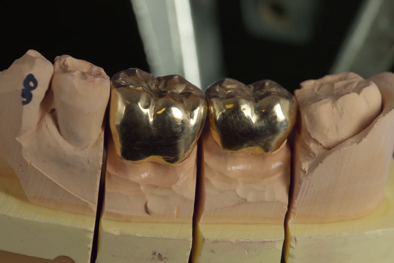 Full cast yellow gold crowns seated on model