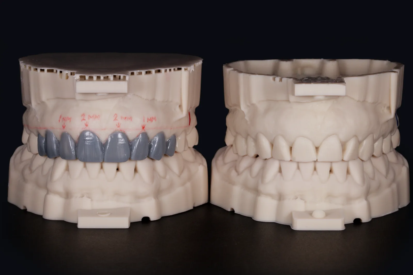 Physical anterior diagnostic wax-up — before and after comparison