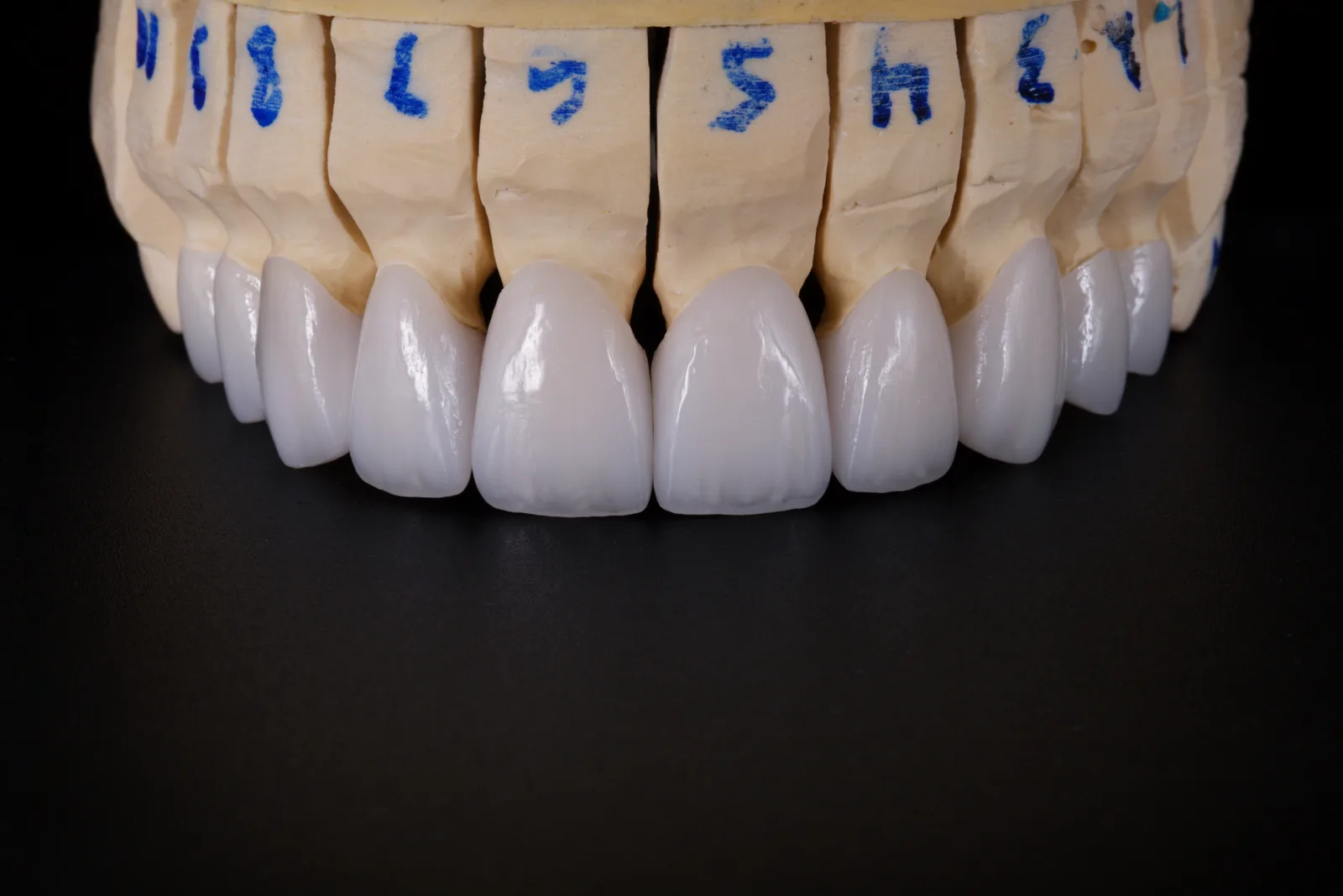 IPS e.max lithium disilicate veneer and crown restoration