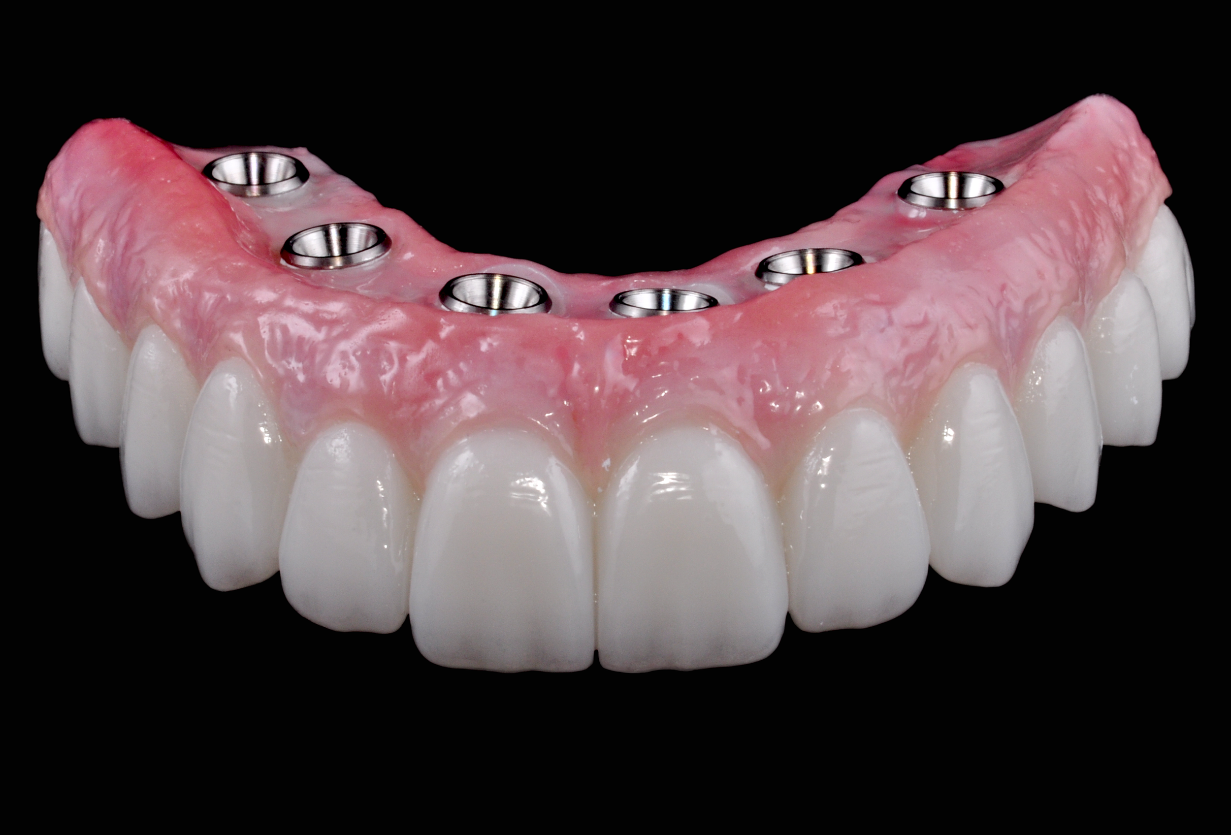 All-on-X full-arch implant restoration