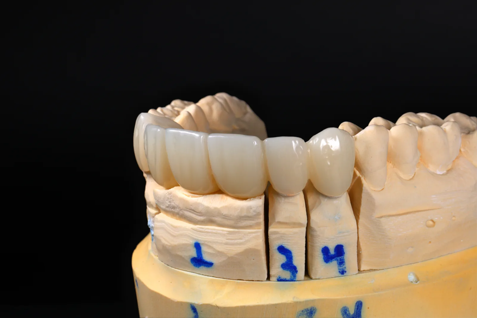 Milled multilayer PMMA temporary bridge
